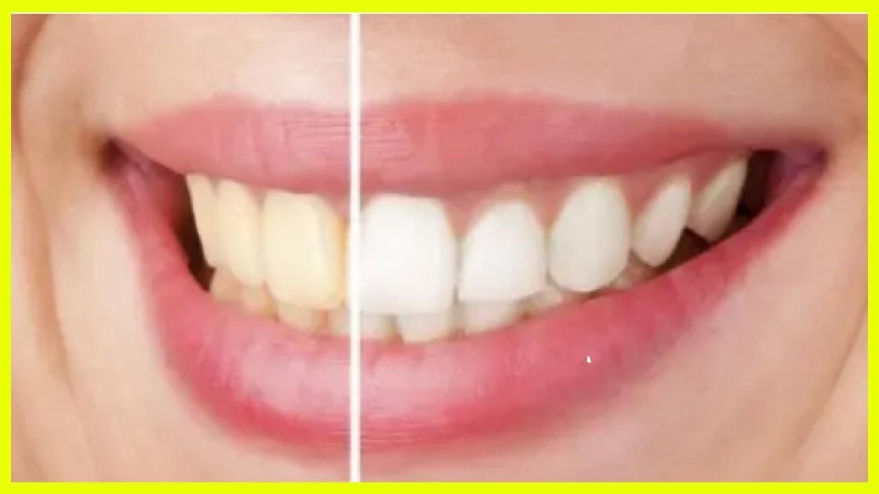 差し歯 を 白く する 方法