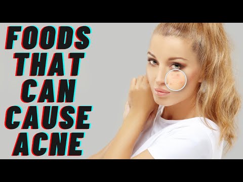 Top 7 Foods That Can Cause Acne