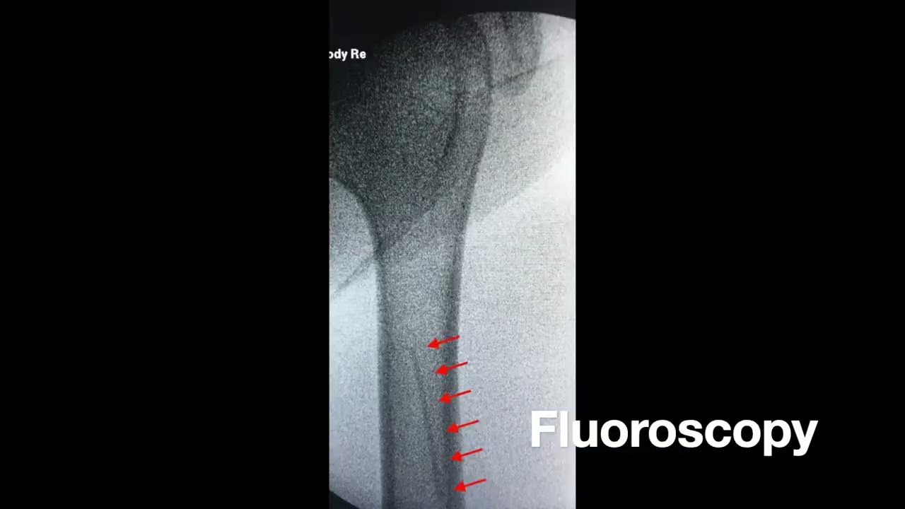 Nexplanon Removal (Contraception Device Removal) YouTube