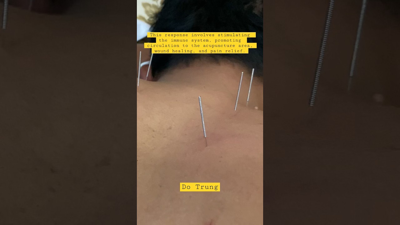 Vietnamese acupuncture acupuncture dotrungofficial YouTube