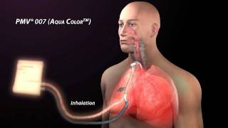 The Passy Muir Valve and Mechanical Ventilation