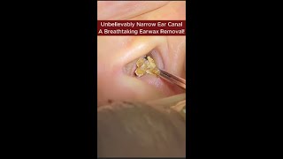 Unbelievably Narrow Ear C A Breathtaking Earwax Removal Deep Ear Cleaning Asmr