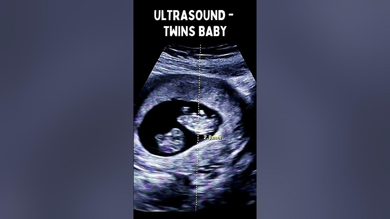 Twins baby movement in Ultrasounds I Twin baby Kicking