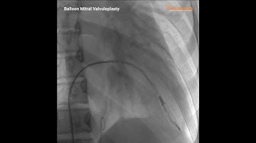 Balloon Mitral Valvuloplasty performed on Premier Elite