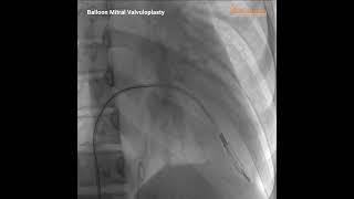 Balloon Mitral Valvuloplasty performed on Premier Elite