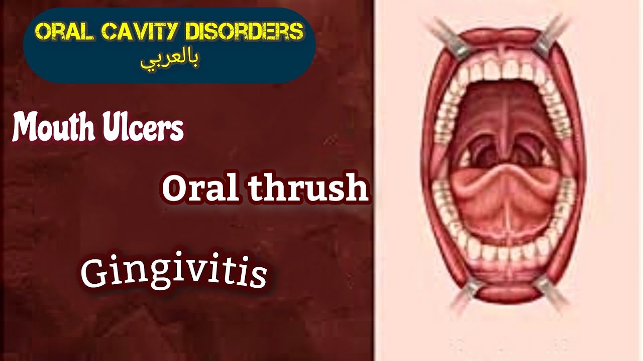 Oral Cavity Disorders بالعربي " Community pharmacy" YouTube