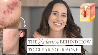 The Science Behind How To Clear Your Acne & Prevent New Breakouts Naturally