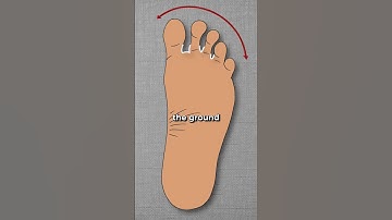 How Bunions Actually Begin… #shorts