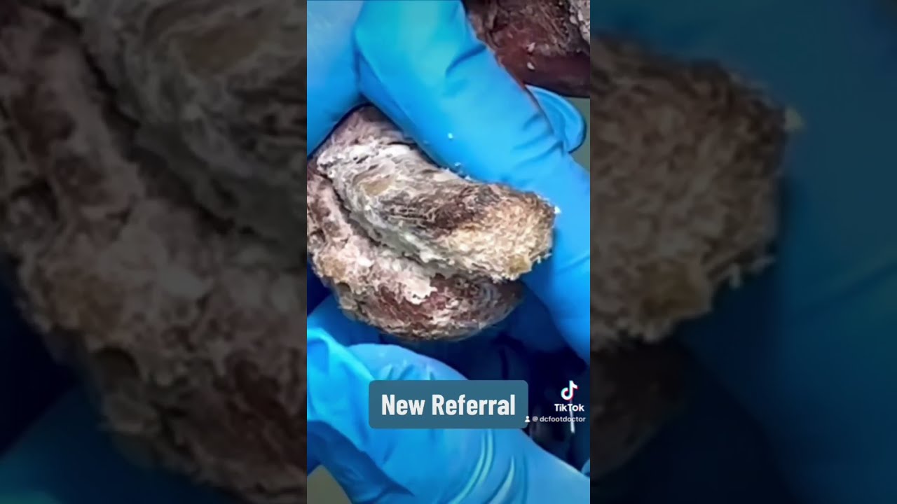 Fungal Toenails Foot Fungaltoenails