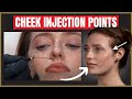 The best cheek filler injection points  where to inject the cheek for beautiful results