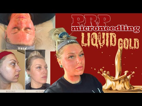 VAMPIRE FACIAL? PRP? MICRONEEDLING? SKINPEN? My Treatment Experience + Healing Process