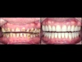 Full mouth rehabilitation for advanced tooth wear case study by Dr. Stephen Phelan