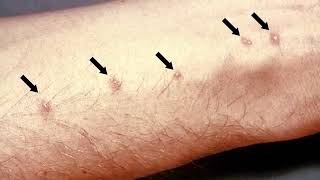 İnsan Vücuduna Girebilen 9 Korkunç Hayvan