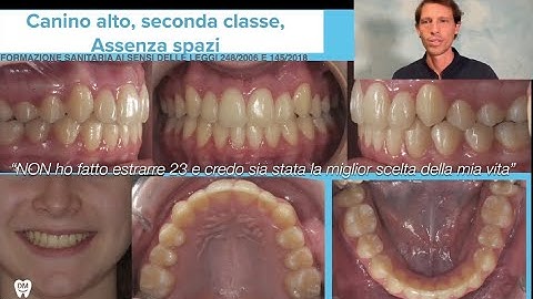 🇬🇧 Class II Malocclusion and High Canine Without Surgery or Extractions | Clear Aligner Orthodontics
