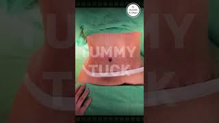 Tummy Tuck Before And After | نقبل وبعدعملية شد ترهلات البطن