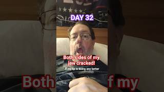 Day 32 - Recovering From A Mini Stroke - Facial Droop