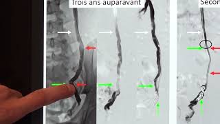 Varicocèle Un Nouveau Ressort