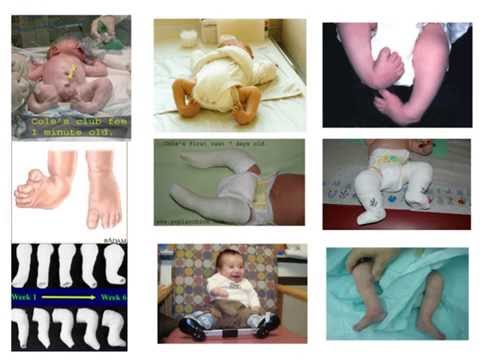 مع د. ستار الحبيب ،حنف القدم الولادي في العراق،قصة طفل مع الحنف من الولادة حتى عمر ال ١٤ شهر