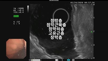 위내시경 내시경 초음파 (Gastric subepithelial tumor, 위상피하종양, 위점막하종양)