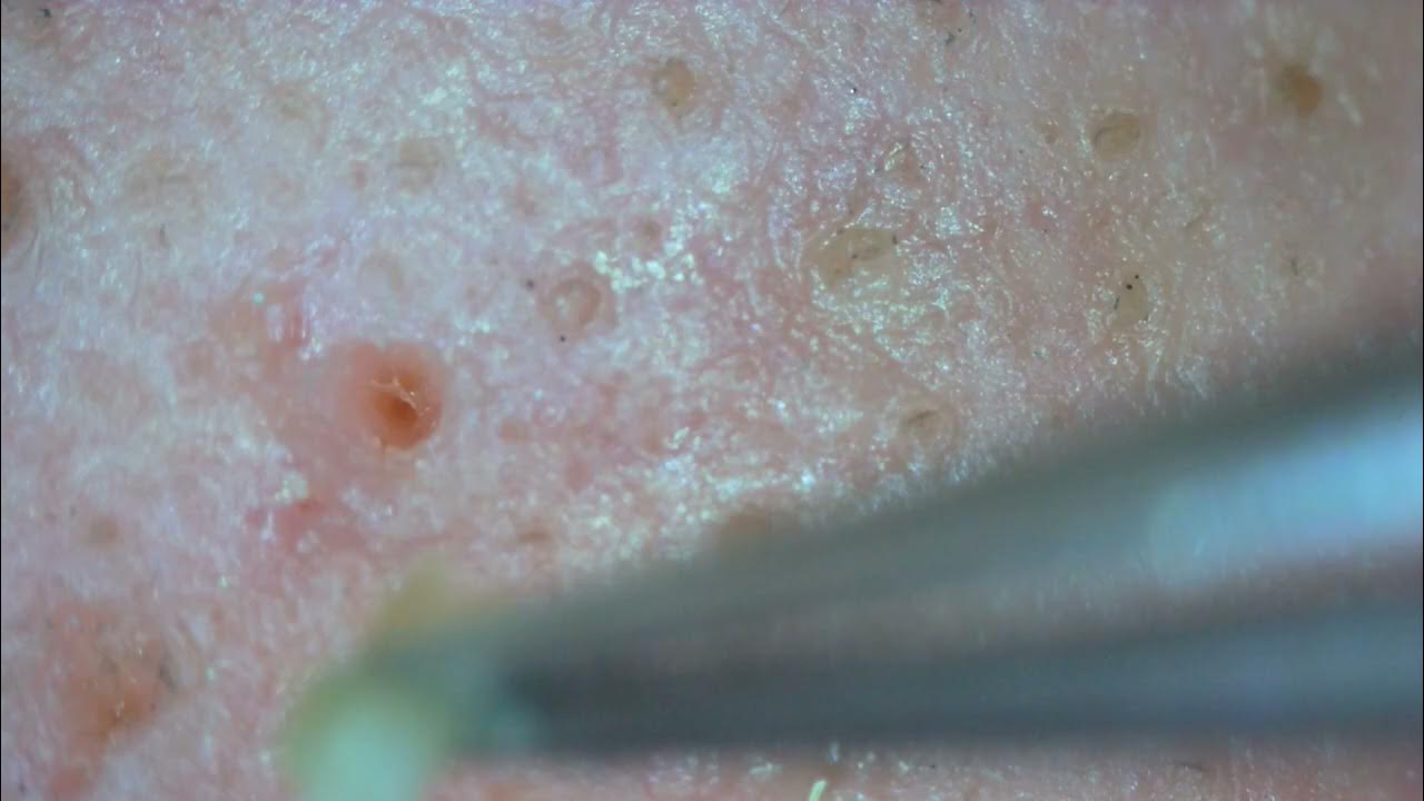 0260 keratin plug removal nose YouTube