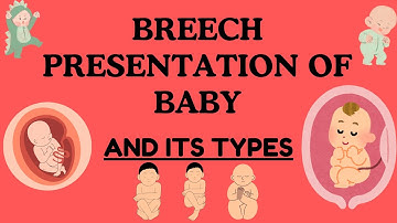 Breech Presentation of Baby: Understanding, Types, Risks, and Delivery Options