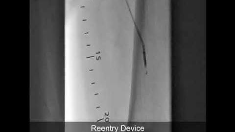 TruePath to Cross Left SFA CTO with Subintimal Re-Entry