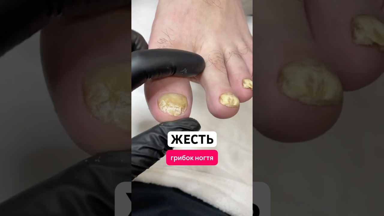 Супер средство от грибка ногтей. Артикул - 67774905