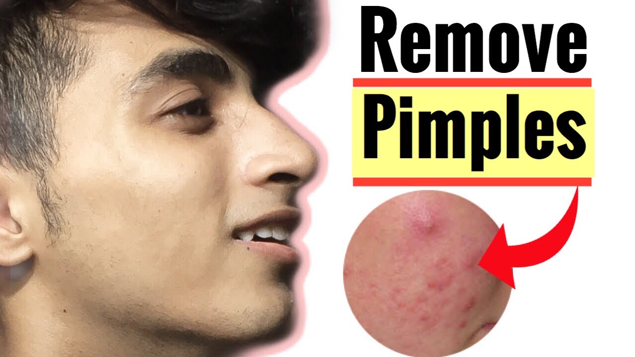 How to remove pimples | how to remove pimples from face for men | Get