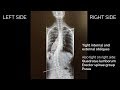 How Muscles Contract in Scoliosis C Curve