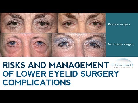 Video: Blepharoplasty: The Main Myths About Eyelid Correction