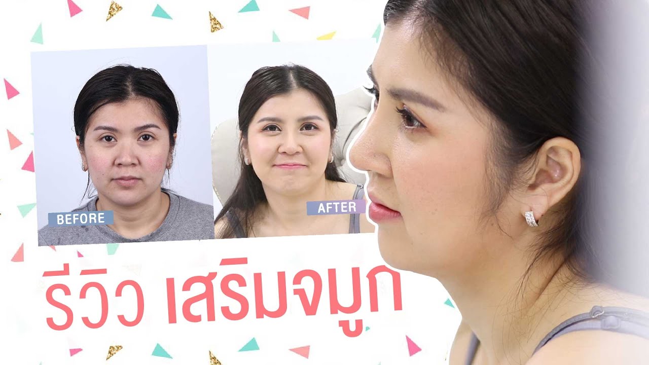 ศัลยกรรมเสริมจมูก หลังทำ 3 สัปดาห์ ธีรพรคลินิก หมอชลธิศ