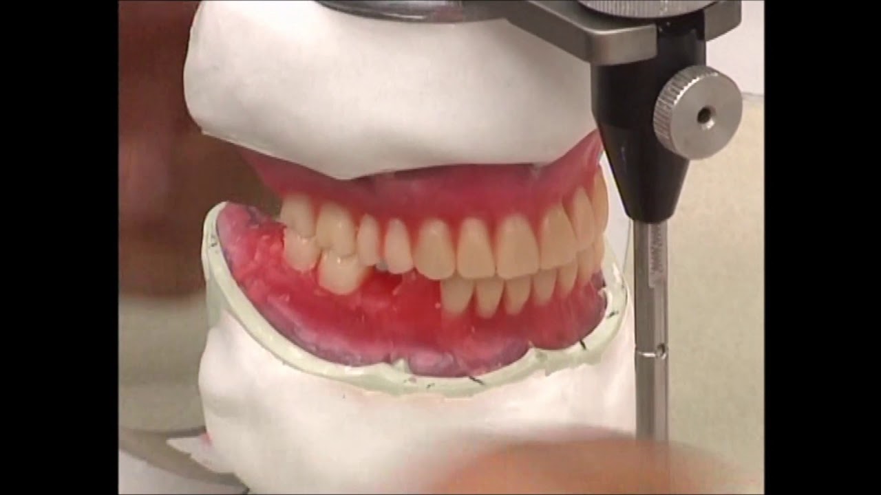 COMPLETE DENTURE: 11. Teeth Setting Up - The Posterior Mandibular Teeth