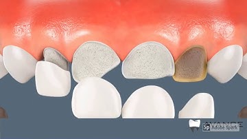 Video tutorial :Dental Veneers, a great Smile Design procedure.