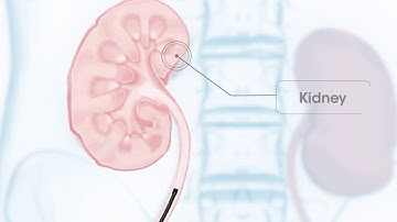Pusen Single Use Ureteroscope Uscope