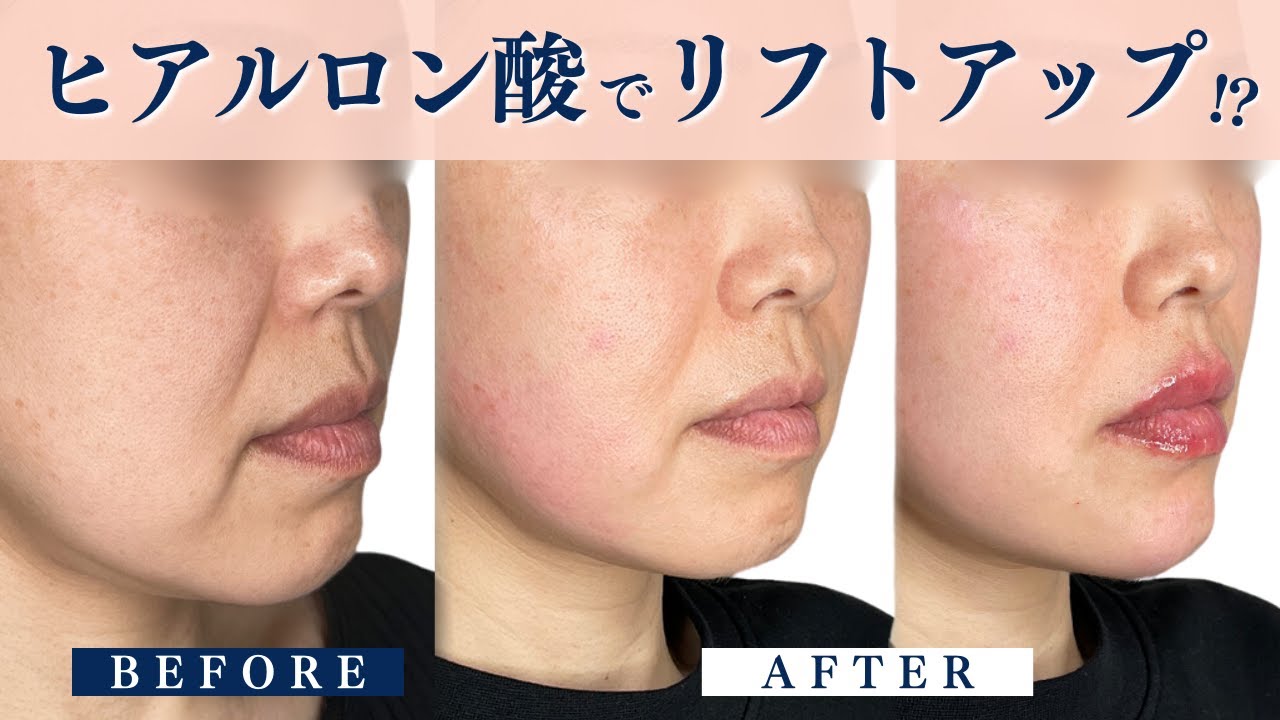 ヒアルロン酸で自然なリフトアップ！？適応や症例も解説！【ヒアルロン酸リフト】