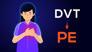 Overview of Acute Pulmonary Embolism in adults: (From DVT to PE)