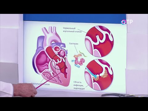 Видео: Инфекциозен ендокардит: симптоми, диагноза и лечение