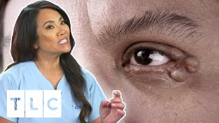 Dr Lee Removes Multiple Cysts From Woman's Eye Lids | Dr. Pimple Popper | CENSORED