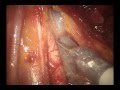 Robotic radical cystectomy with intracorporeal ileal neobladder  prof dr ioan coman