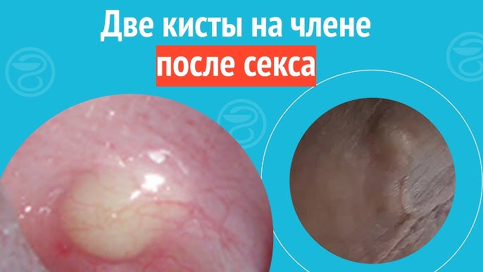 Фимоз полового члена - приговор для женщин? Фимоз полового члена - приговор для женщин?