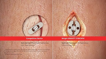 GRAVITY™ SYNCHFIX™ Syndesmosis Fixation Device Animation