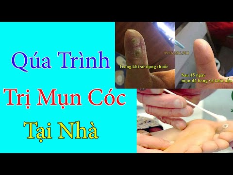 [ Tóm Tắt ] Qúa Trình Trị Mụn Cóc Tại Nhà Hiệu Qủa