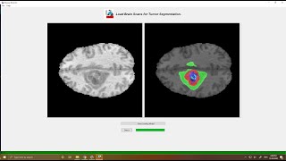Brain Tumor Segmentation via BU-Net | GUI/ Front-End
