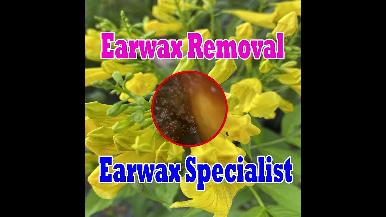 Over Softened Ear Wax Plug Extracted in Patient with Benign Osteonecrosis YouTube