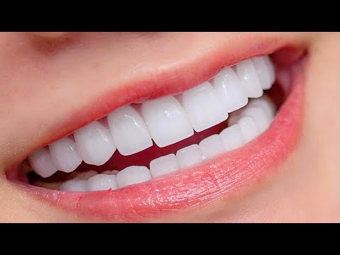 Video cận cảnh lắp răng sứ #veneers KHÔNG BỊ MÀI QUÁ NHỎ... - youtube