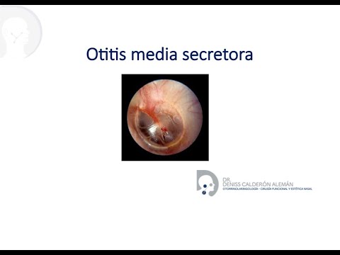 Video: Otitis Crónica