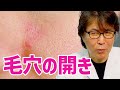顔、頬の『毛穴開き』が気になる人、毎日使う「アレ」をやめてください