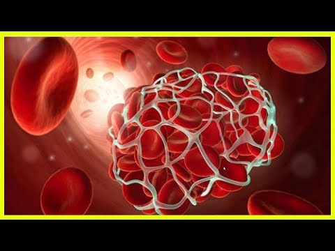 Vidéo: Prévention De La Thrombose - Top 5 Des Aliments Interdits Pour La Thrombose