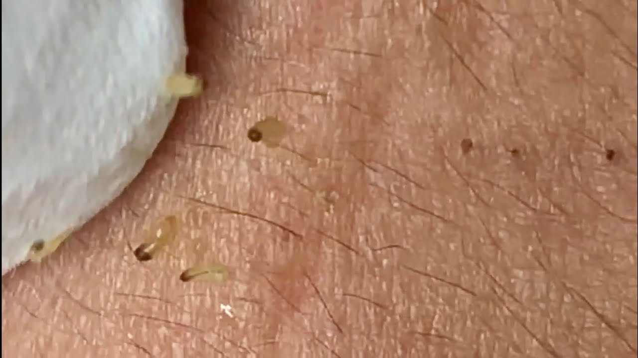 🔥 Pimple Popping 2020 Super Blackheads Extraction Blackheads Removal