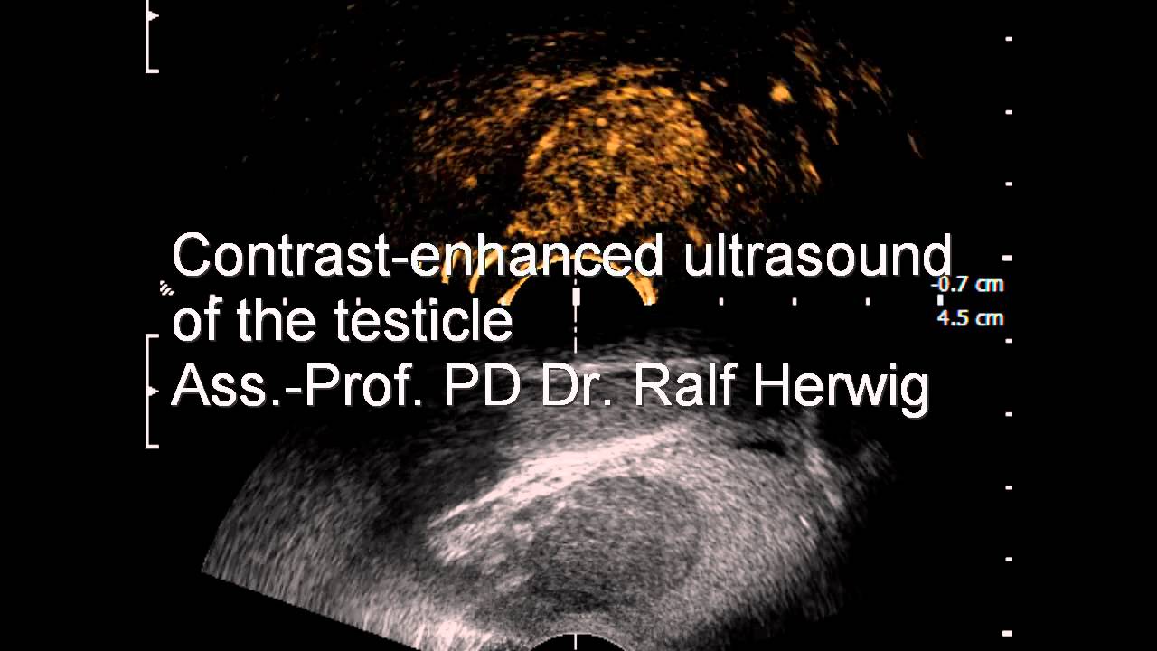 contrast enhanced ultrasound testicular cancer testicular ultrasound